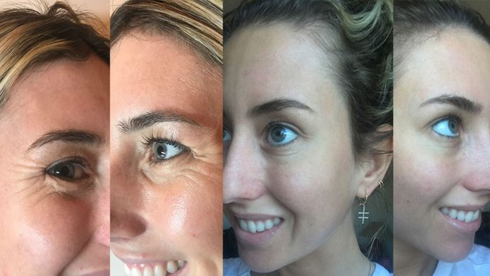 Dr. Milojević in Marie Claire: "What is Baby Botox and why are more young women than ever having it done?"