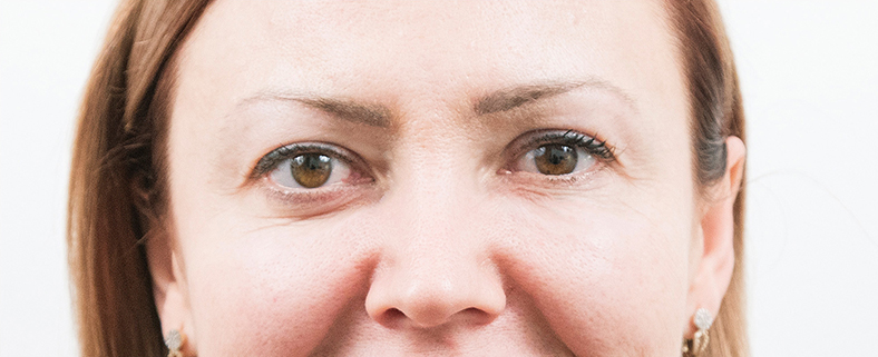 Baby Botox, poslije
