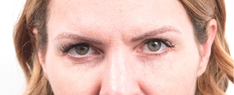 Baby Botox, poslije