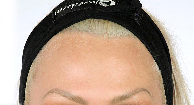 Baby injekcije za bore, Baby Botox, sl. 2 - poslije