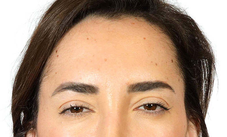 Baby injekcije za bore, Baby Botox, sl. 3 - poslije