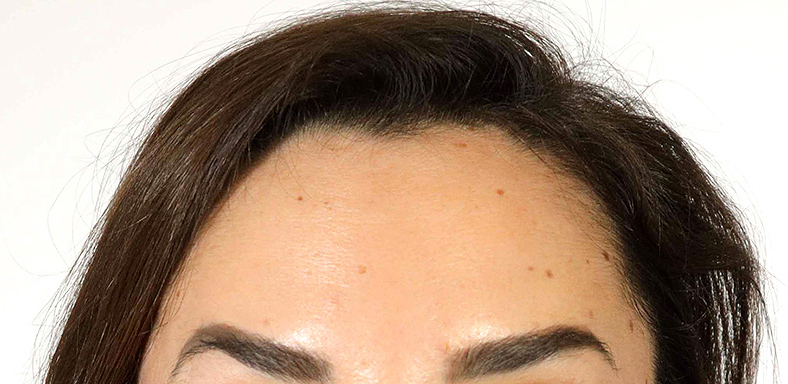Baby injekcije za bore, Baby Botox, sl. 4 - poslije