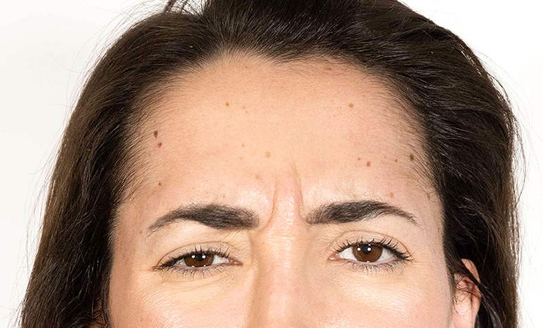 Baby injekcije za bore, Baby Botox, sl. 3 - prije