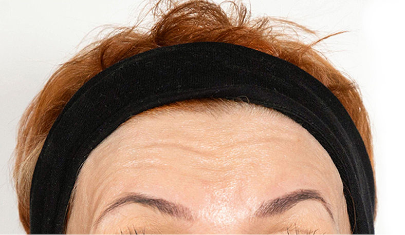 Baby injekcije za bore, Baby Botox, sl. 2 - prije