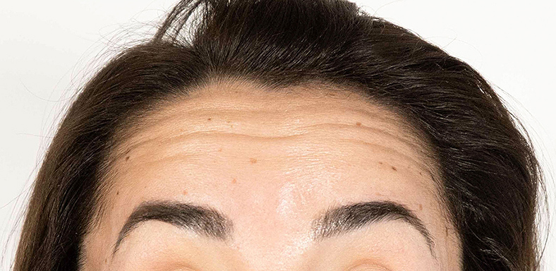 Baby injekcije za bore, Baby Botox, sl. 4 - prije
