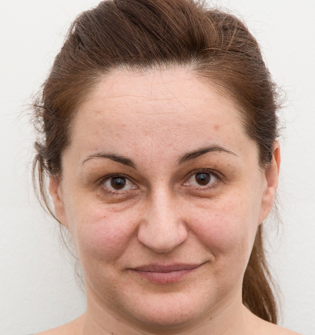 Dermalni fileri - prije 3