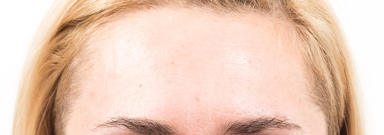 Baby Botox, poslije