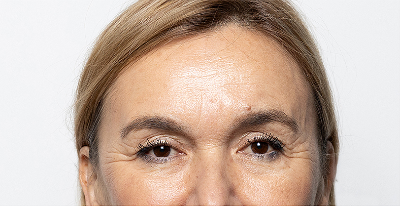 Injekcije za bore, Botox, sl. 1 - prije