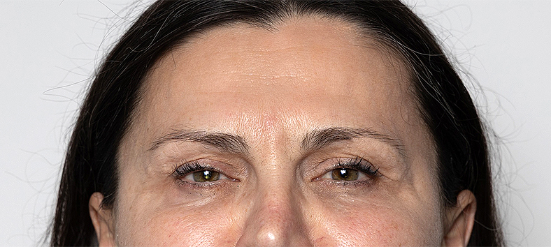 Botox - Injekcije za bore, sl. 2 - poslije