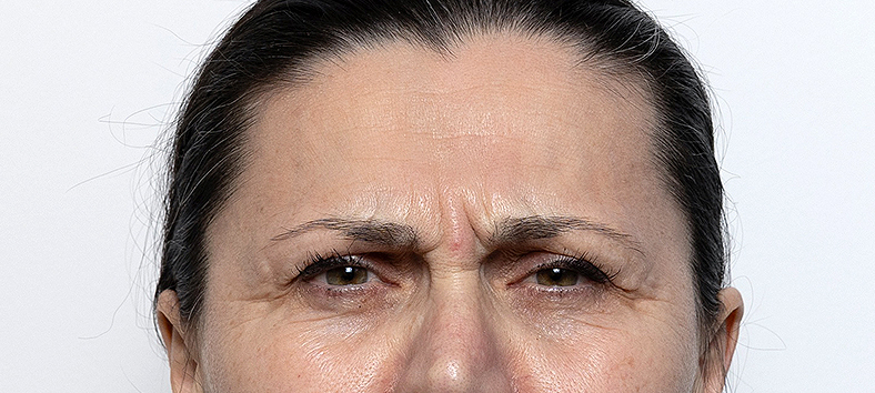 Botox - Injekcije za bore, sl. 2 - prije