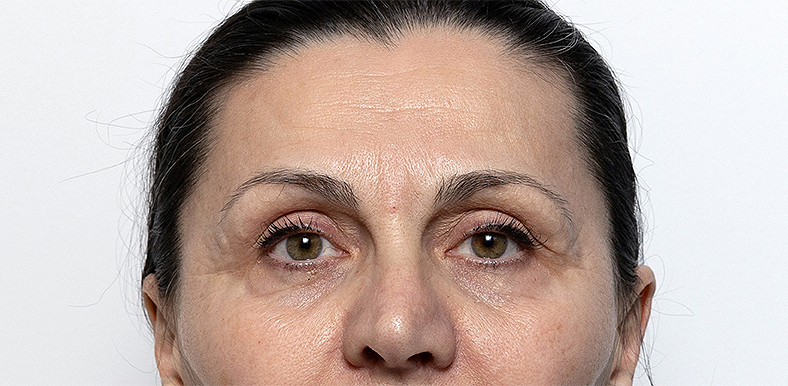 Injekcije za bore, Botox, sl. 1 - prije