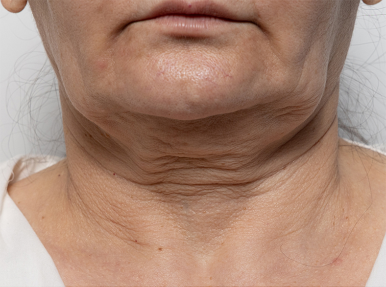 Injekcije za bore, Botox, sl. 4 - prije