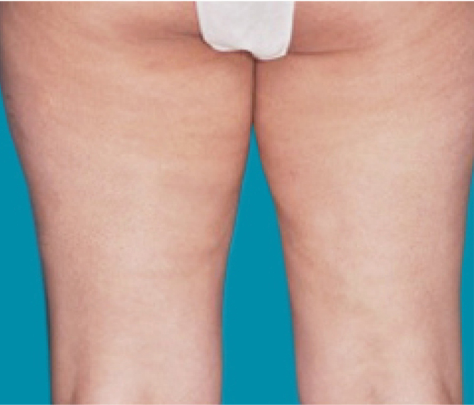 Body Shape - poslije 4