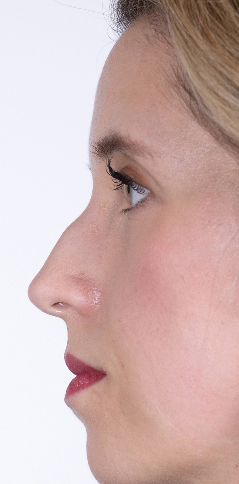Nekirurška korekcija nosa - prije, sl. 3 2022