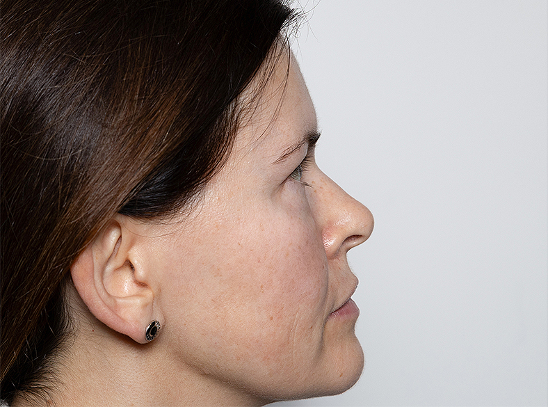 Nekirurško uklanjanje podočnjaka, poslije