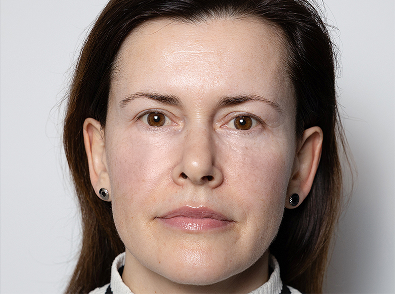 Nekirurško uklanjanje podočnjaka, poslije