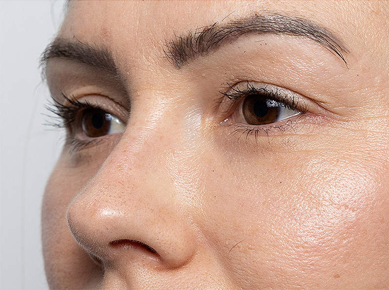 Nekirurško uklanjanje podočnjaka - poslije 5