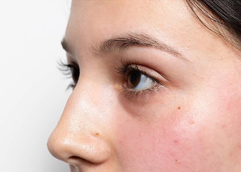 Nekirurško uklanjanje podočnjaka - prije 4