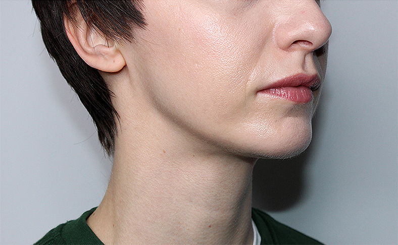 Oblikovanje brade i vilice dermalnim filerom, 2026. sl. 1 - poslije