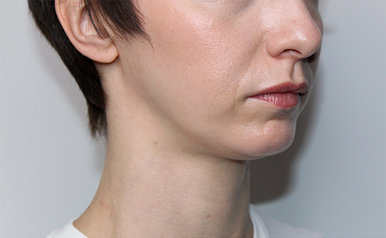 Oblikovanje brade i vilice dermalnim filerom, 2026. sl. 1 - prije