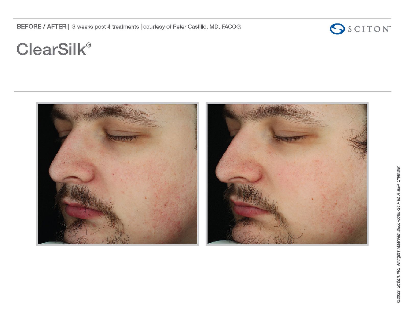 ClearSilk - pomlađivanje kože, sl. 3