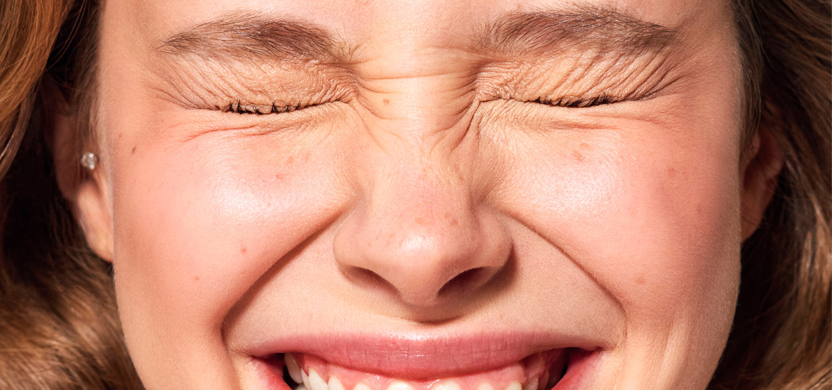 Gummy Smile