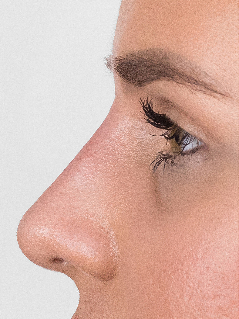 Nekirurška korekcija nosa - poslije, sl. 1