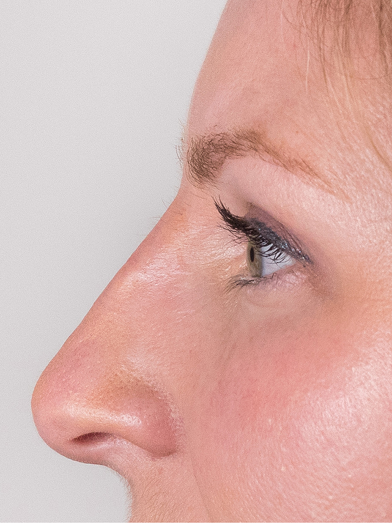 Nekirurška korekcija nosa - poslije, sl. 3