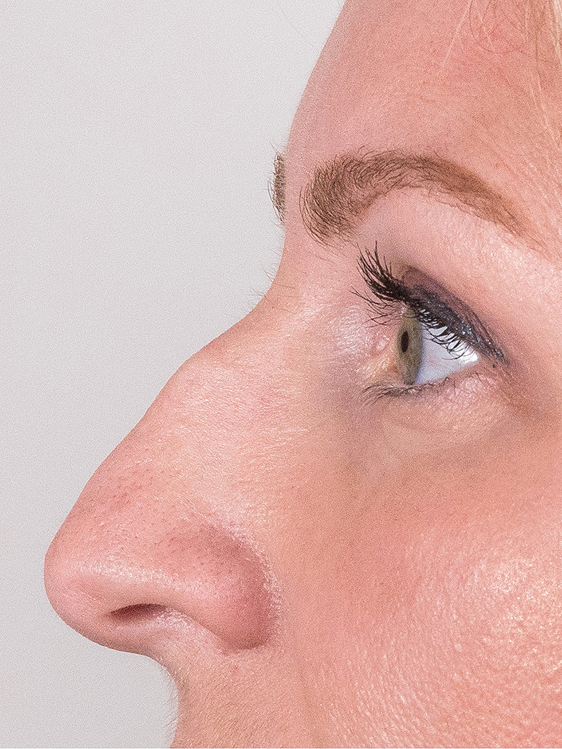 Nekirurška korekcija nosa - prije, sl. 3