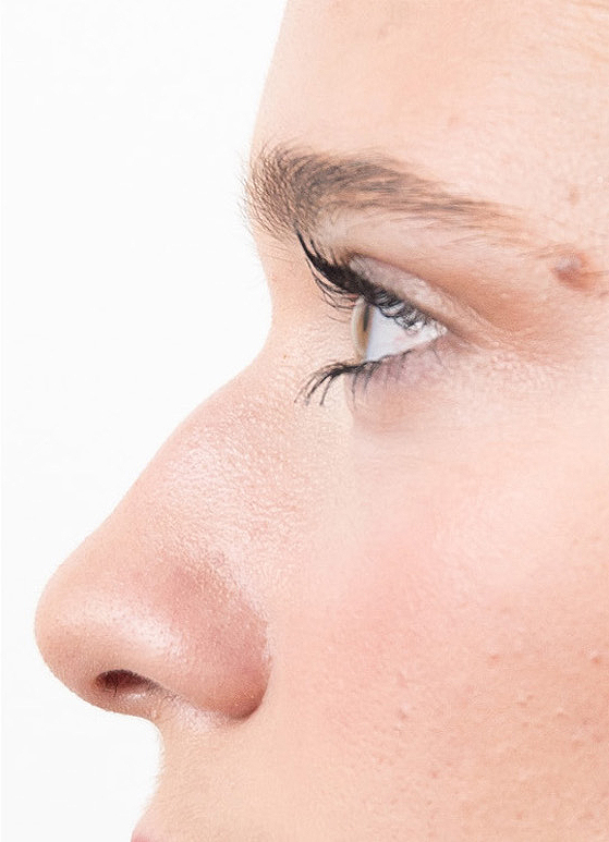 Nekirurška korekcija nosa - prije
